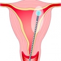 Микроволновая аблация эндометрия (МЕА)