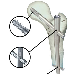 Интрамедуллярный остеосинтез при переломах проксимальной и дистальной третей диафиза большеберцовой кости с интраоперационной двухштырьковой внешней фиксацией