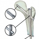 Интрамедуллярный остеосинтез при переломах проксимальной и дистальной третей диафиза большеберцовой кости с интраоперационной двухштырьковой внешней фиксацией