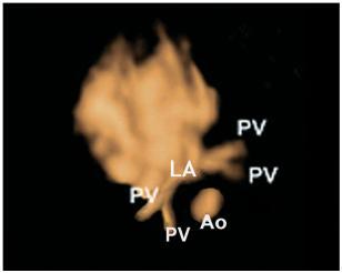 Нормальное впадение легочных вен (PV) в левое предсердие (LA), Ао - грудная аорта.